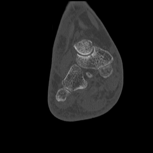 File:Calcaneal tuberosity avulsion fracture (Radiopaedia 22649-22668 Coronal bone window 41).jpg