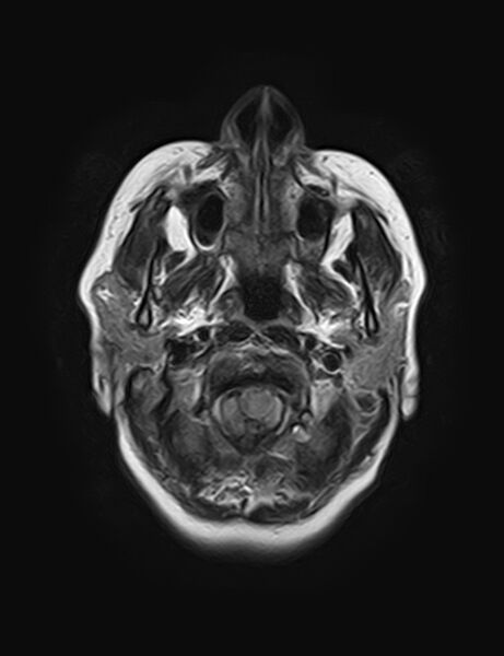 File:Calcified cerebral hydatid cyst (Radiopaedia 65603-74699 Axial FLAIR 2).jpg