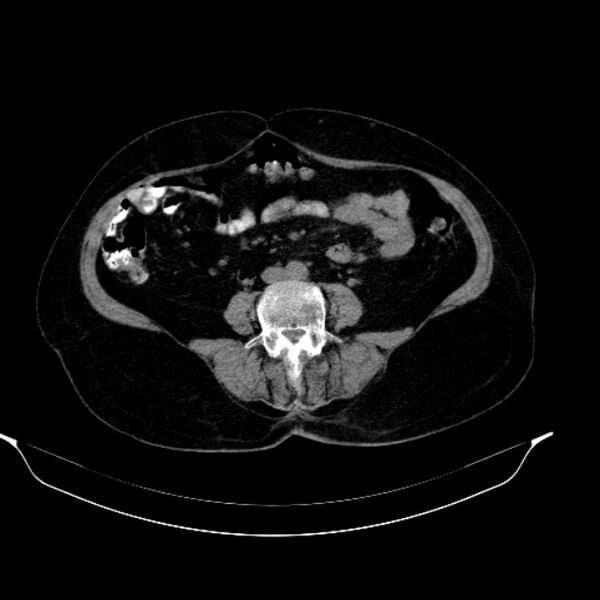 File:Calcified hydatid cyst (Radiopaedia 62000-70085 Axial non-contrast 66).jpg