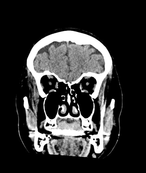 File:Calcified meningioma (Radiopaedia 74361-85243 Coronal non-contrast 9).jpg