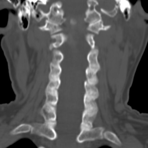 File:Calcified meningioma - cervical canal (Radiopaedia 70136-80171 Coronal bone window 11).jpg