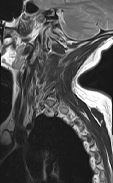 File:Calcified meningioma - cervical canal (Radiopaedia 70136-82468 Sagittal T2 2).jpg