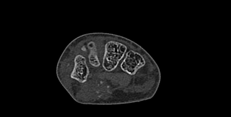 File:Calcifying aponeurotic fibroma (Radiopaedia 88423-105064 Axial bone window 101).jpg