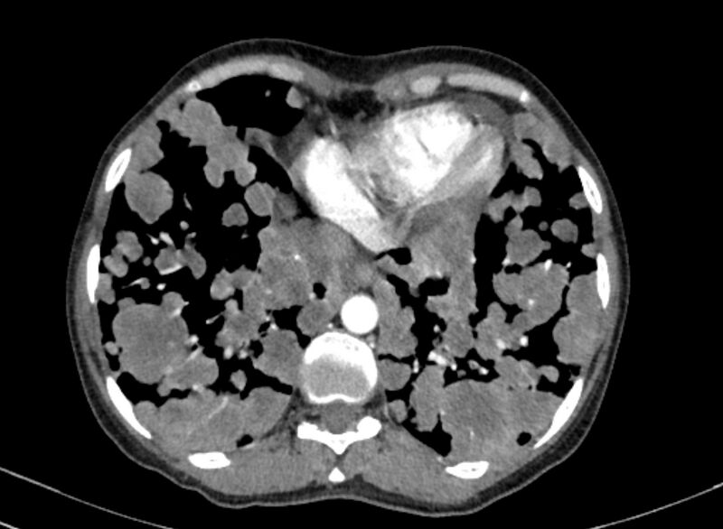 File:Cannonball metastases from breast cancer (Radiopaedia 91024-108569 A 94).jpg