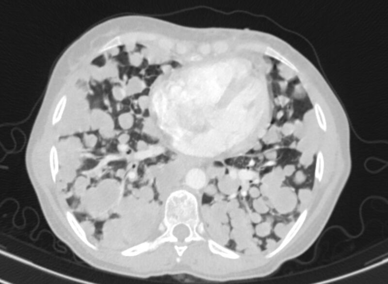 File:Cannonball metastases from breast cancer (Radiopaedia 91024-108569 Axial lung window 64).jpg