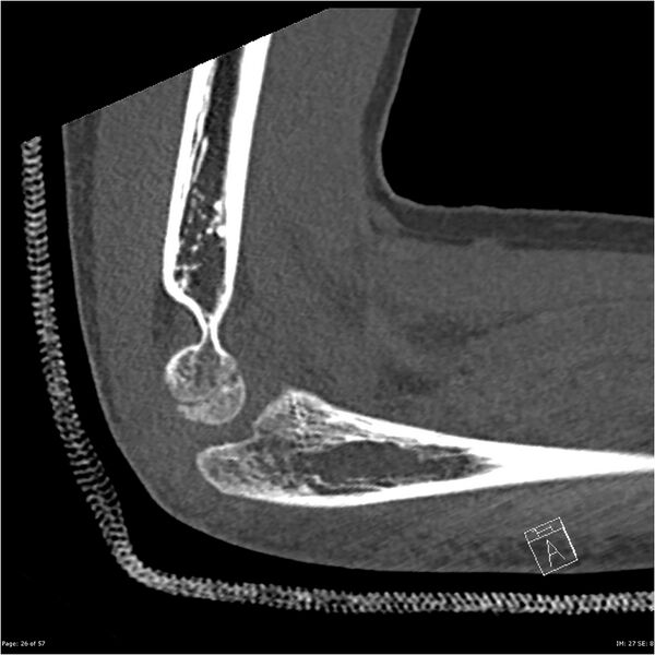 File:Capitellum fracture (Radiopaedia 23352-23426 Sagittal bone window 26).jpg