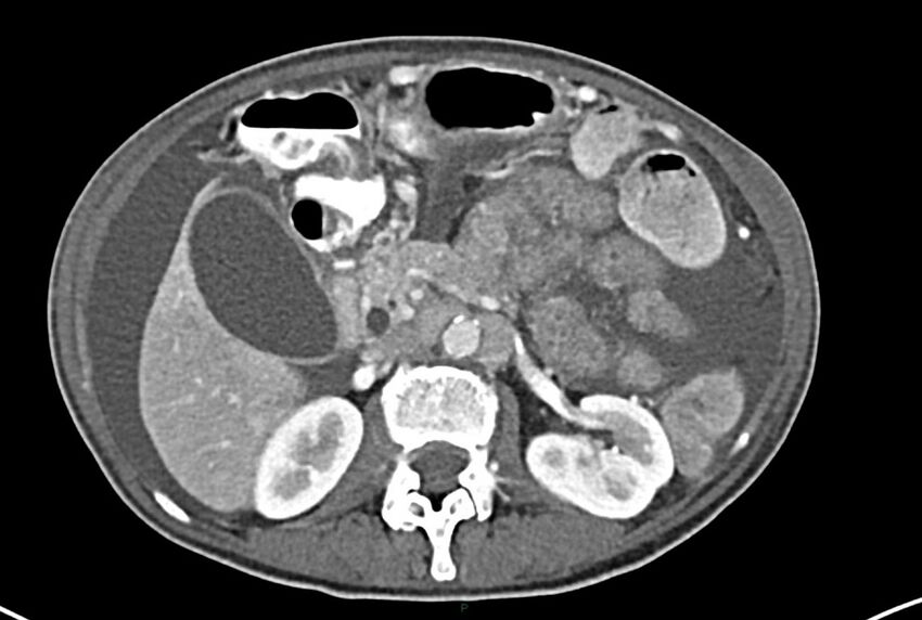 Carcinoid mesenteric tumor complicated by chylous ascites (Radiopaedia 76312-87953 A 27).jpg