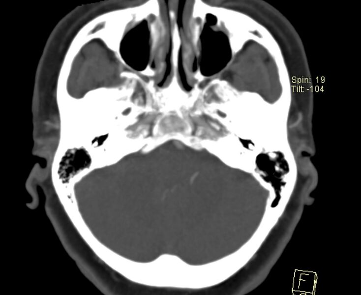 File:Caroticocavernous fistula (Radiopaedia 29565-30069 Axial MIP 5).jpg