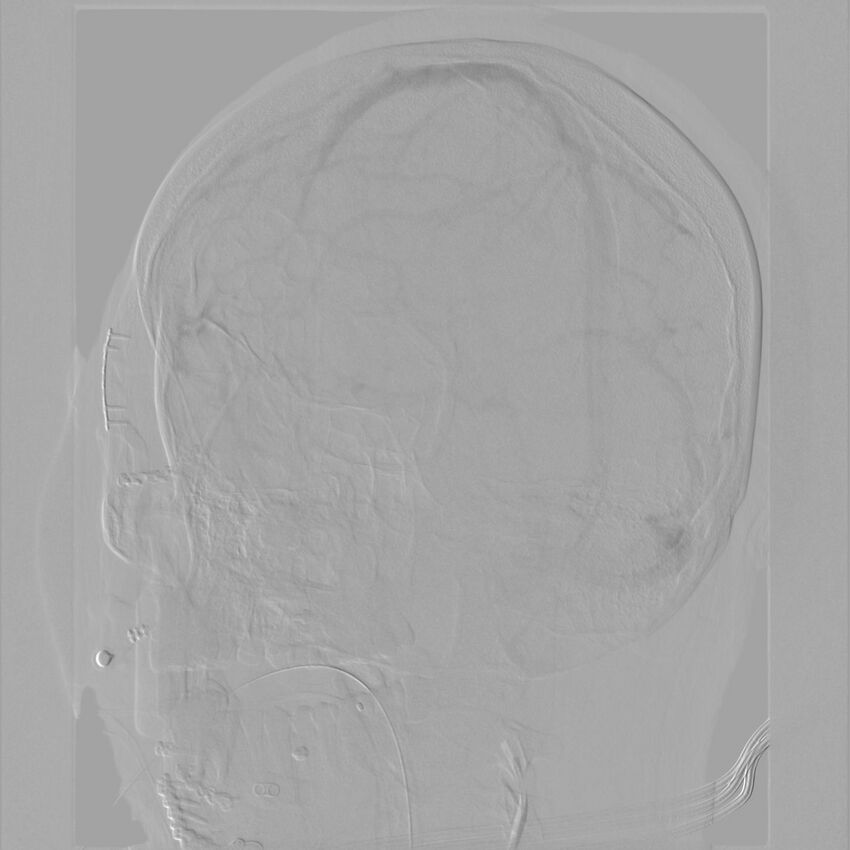Caroticocavernous fistula - direct (Radiopaedia 61660-69666 Oblique Left ICA 59).jpg