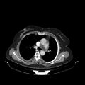 Carotid body tumor (Radiopaedia 21021-20948 B 35).jpg