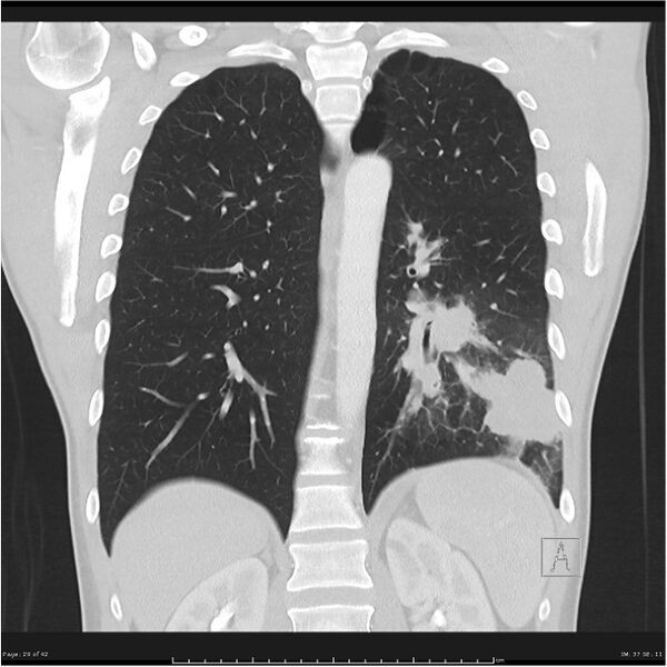 File:Cavitating lung cancer (Radiopaedia 25796-25945 lung window 29).jpg