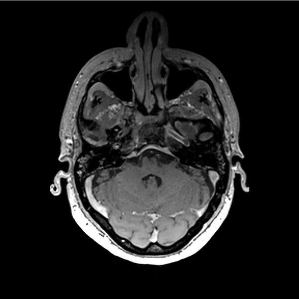 File:Central base of skull meningioma (Radiopaedia 53531-59549 Axial T1 C+ 2).jpg