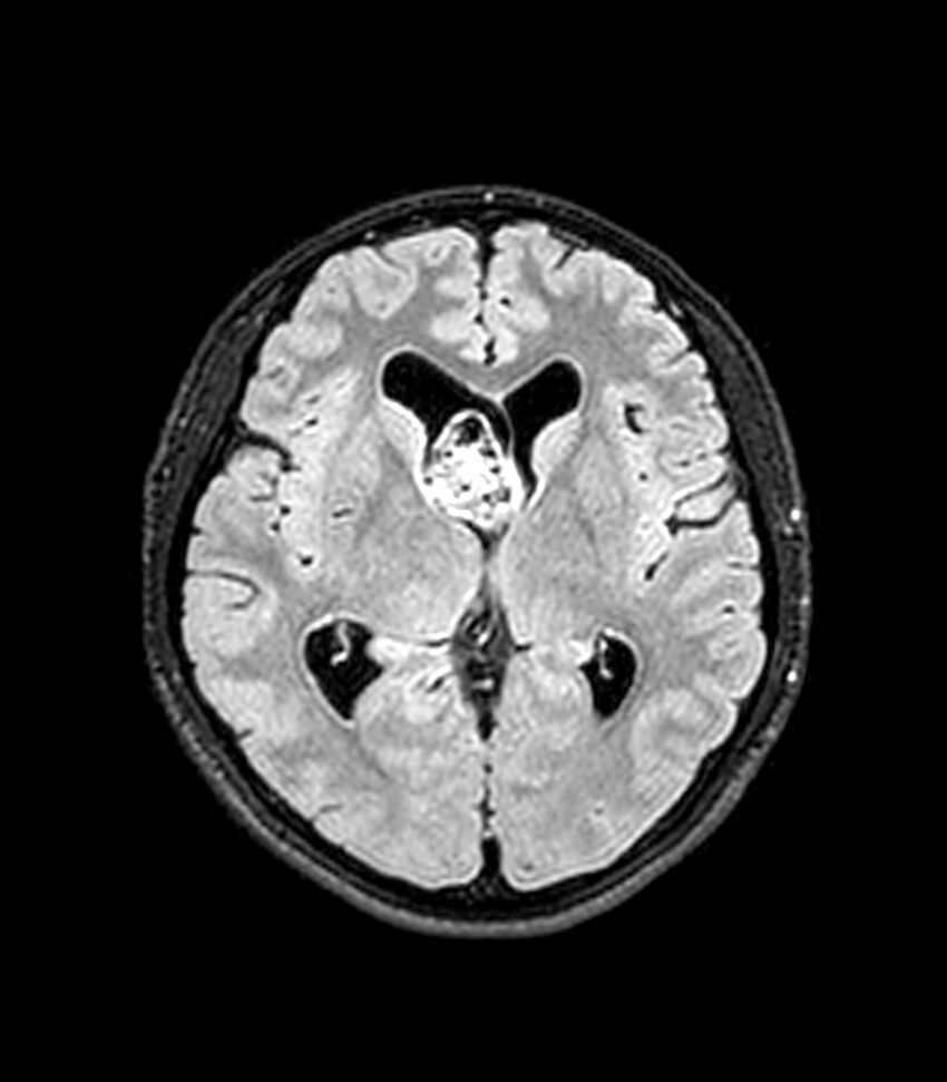 Central neurocytoma (Radiopaedia 79320-92380 Axial FLAIR 161).jpg