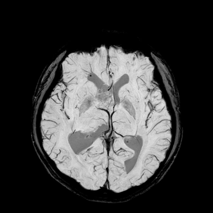 Central neurocytoma (Radiopaedia 79320-92380 Axial SWI 68).jpg