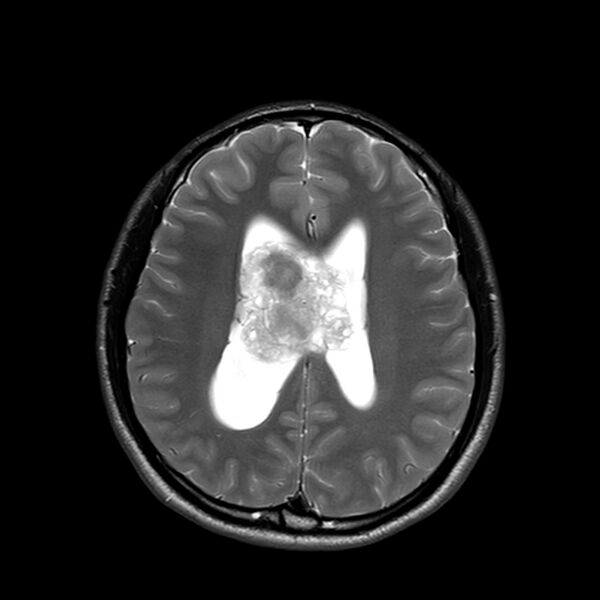 File:Central neurocytoma (Radiopaedia 79320-92380 Axial T2 18).jpg