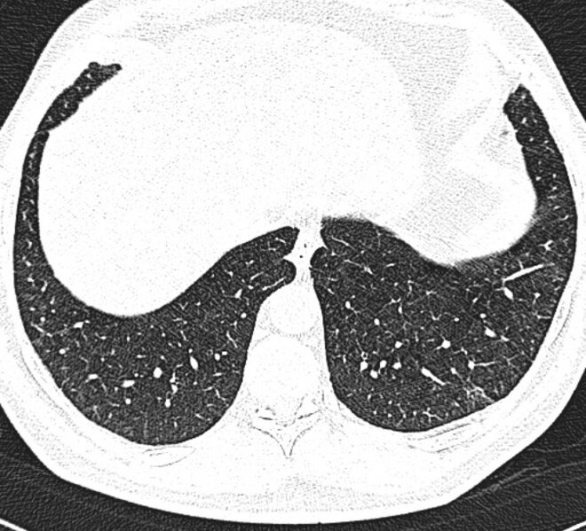 File:Centrilobular pulmonary emphysema (Radiopaedia 26808-26971 Axial lung window 32).jpg