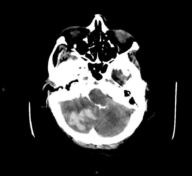 File:Cerebellar hemorrhage (Radiopaedia 58792-66026 Axial non-contrast 41).jpg