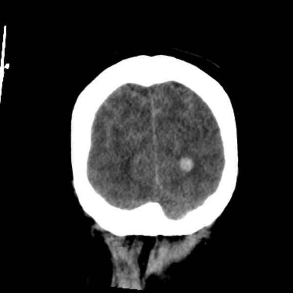 File:Cerebellar hemorrhage causing obstructive hydrocephalus (Radiopaedia 33989-35207 Coronal non-contrast 48).jpg