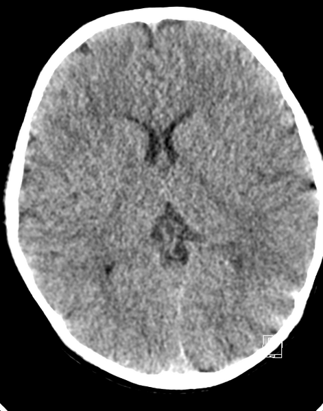 File:Cerebellar stroke (Radiopaedia 32202-33149 Axial non-contrast 13).png
