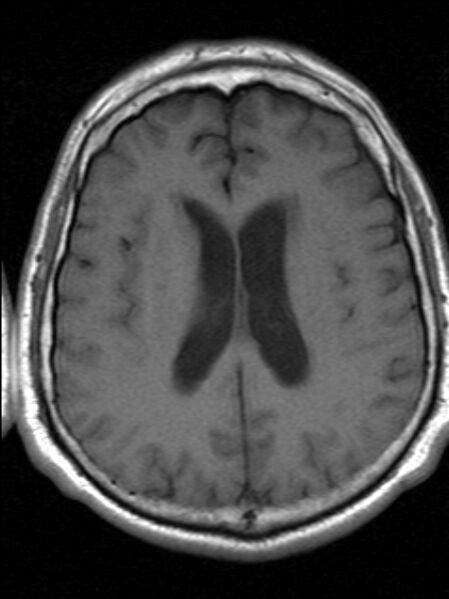 File:Cerebellopontine angle meningioma (Radiopaedia 24459-24764 Axial T1 15).jpg