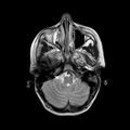 Cerebral abscess post cardiac surgery (Radiopaedia 27244-27420 Axial T2 4).jpg