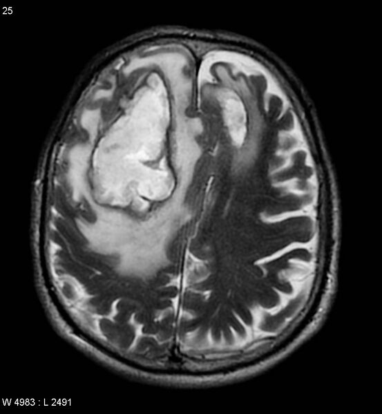 File:Cerebral abscesses secondary to contusions (Radiopaedia 5201-6968 Axial T2 6).jpg