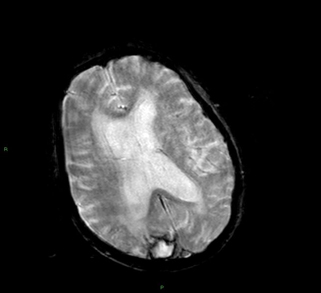 File:Cerebral amyloid angiopathy-associated lobar intracerebral hemorrhage (Radiopaedia 58377-65515 Axial Gradient Echo 12).jpg