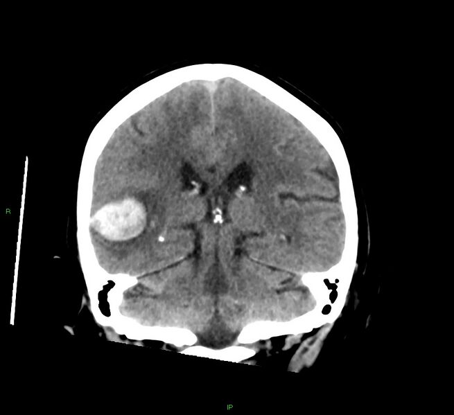 File:Cerebral amyloid angiopathy-associated lobar intracerebral hemorrhage (Radiopaedia 58378-65516 Coronal non-contrast 26).jpg