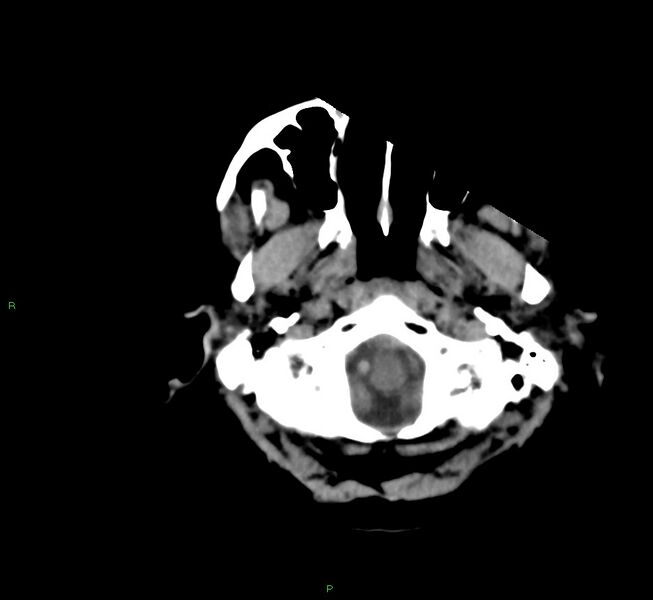 File:Cerebral amyloid angiopathy-associated lobar intracerebral hemorrhage (Radiopaedia 58561-65724 Axial non-contrast 43).jpg