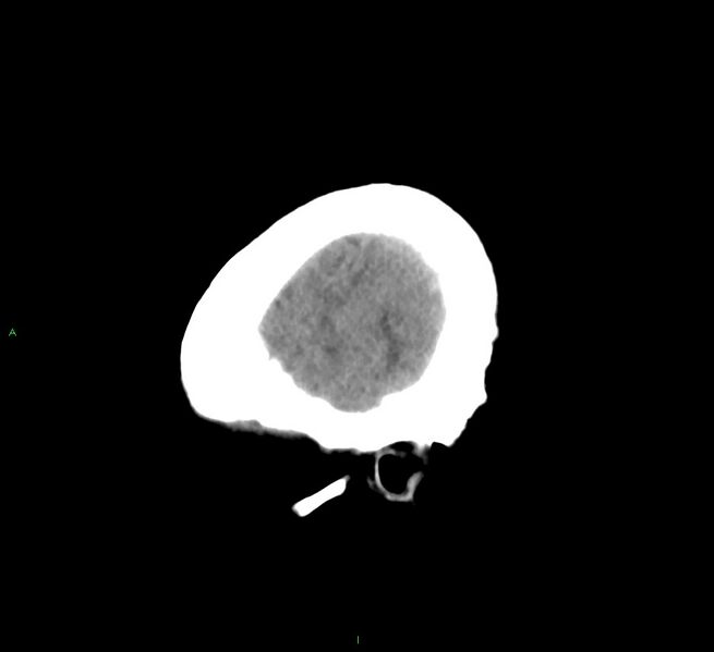 File:Cerebral amyloid angiopathy-associated lobar intracerebral hemorrhage (Radiopaedia 58563-65727 C 8).jpg