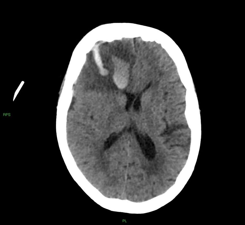Cerebral amyloid angiopathy-associated lobar intracerebral hemorrhage (Radiopaedia 58569-65734 Axial non-contrast 30).jpg