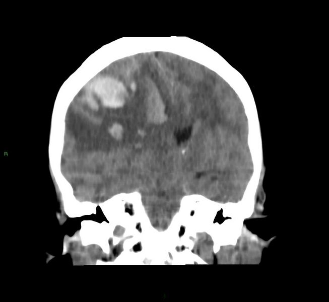 File:Cerebral amyloid angiopathy-associated lobar intracerebral hemorrhage (Radiopaedia 58751-65972 Coronal non-contrast 33).jpg