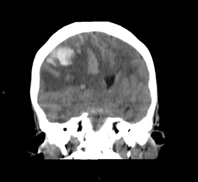File:Cerebral amyloid angiopathy-associated lobar intracerebral hemorrhage (Radiopaedia 58751-65972 Coronal non-contrast 34).jpg