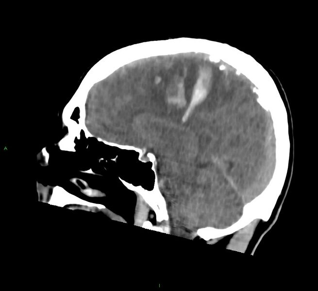 File:Cerebral amyloid angiopathy-associated lobar intracerebral hemorrhage (Radiopaedia 58756-65977 C 28).jpg