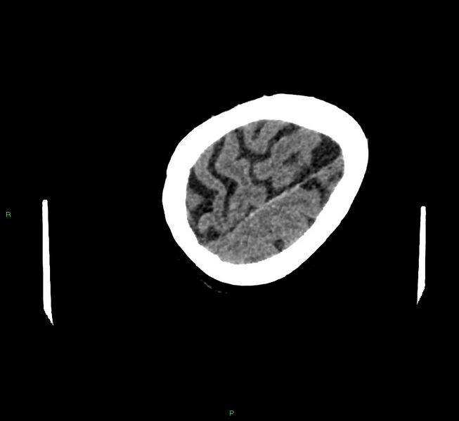 File:Cerebral amyloid angiopathy-associated lobar intracerebral hemorrhage (Radiopaedia 58757-65979 Axial non-contrast 126).jpg