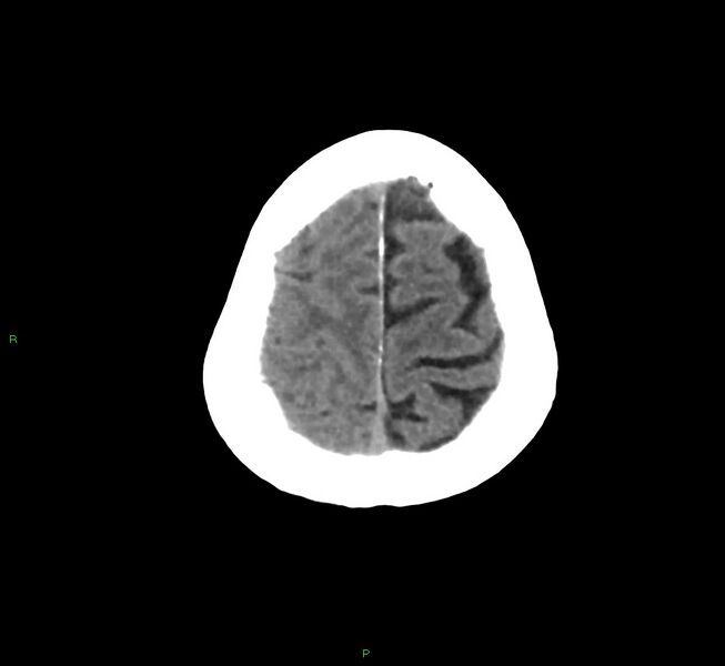 File:Cerebral amyloid angiopathy-associated lobar intracerebral hemorrhage (Radiopaedia 58758-65980 Axial non-contrast 8).jpg