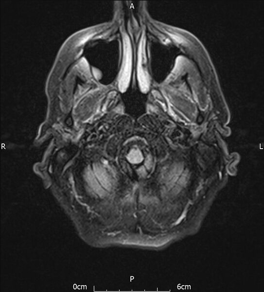 File:Cerebral amyloid angiopathy related inflammation (Radiopaedia 72772-83415 Axial FLAIR 3).jpg