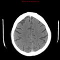 Cerebral and orbital tuberculomas (Radiopaedia 13308-13310 B 22).jpg