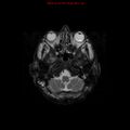 Cerebral and orbital tuberculomas (Radiopaedia 13308-13311 Axial T2 4).jpg