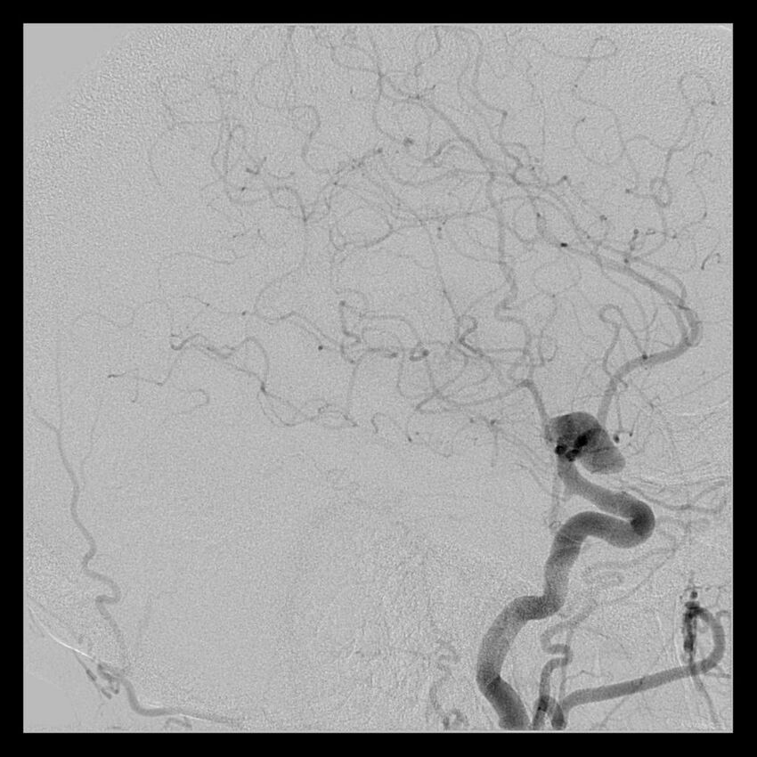 Cerebral aneurysm with rupture (Radiopaedia 29933-30458 LT ICA IC 41).jpg