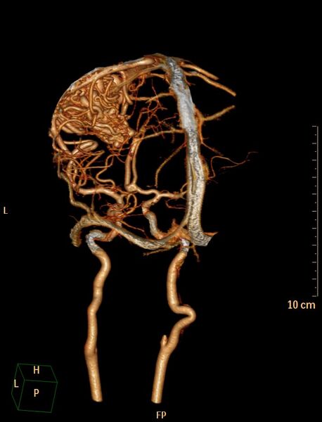 File:Cerebral arteriovenous malformation (Radiopaedia 29531-30031 B 12).jpg