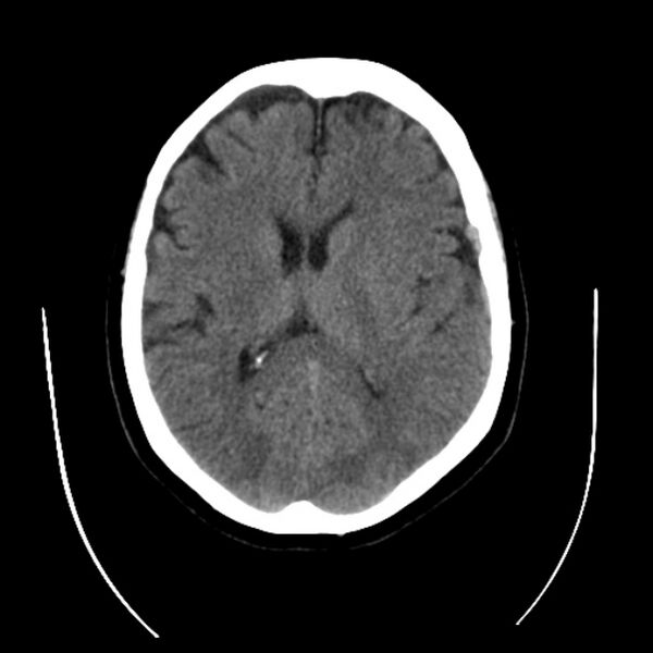 File:Cerebral arteriovenous malformation (Radiopaedia 43729-47189 Axial non-contrast 23).jpg