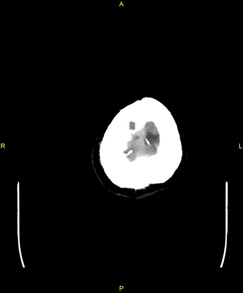 File:Cerebral autosomal dominant arteriopathy with subcortical infarcts and leukoencephalopathy (CADASIL) (Radiopaedia 86108-102051 Axial non-contrast 112).jpg