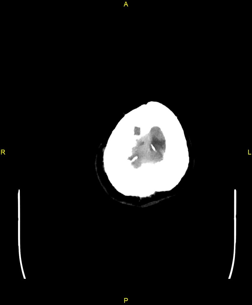 Cerebral autosomal dominant arteriopathy with subcortical infarcts and leukoencephalopathy (CADASIL) (Radiopaedia 86108-102051 Axial non-contrast 112).jpg