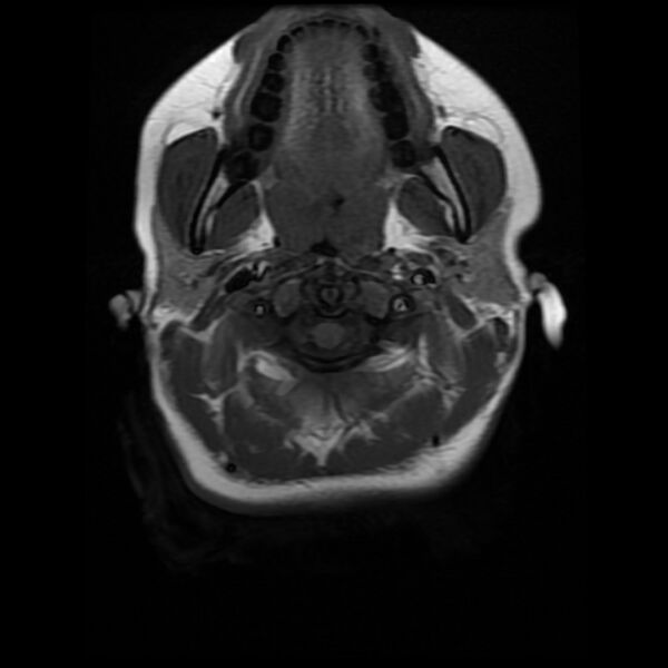 File:Cerebral cavernous malformation (Radiopaedia 44301-47942 Axial T1 1).jpg