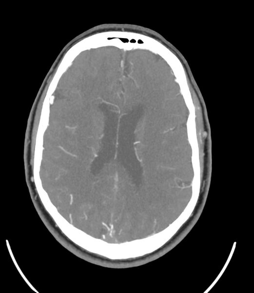 File:Cerebral dural venous sinus thrombosis (Radiopaedia 86514-102576 A 64).jpg