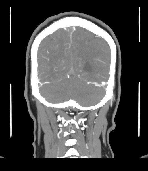 File:Cerebral dural venous sinus thrombosis (Radiopaedia 86514-102576 B 60).jpg