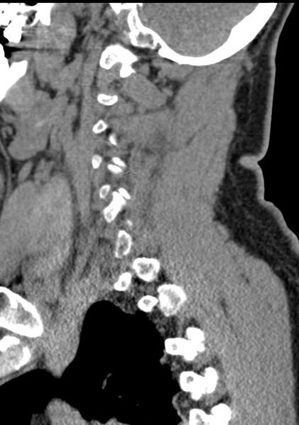 File:Cerebral hemorrhagic contusions and cervical spine fractures (Radiopaedia 32865-33841 G 78).jpg