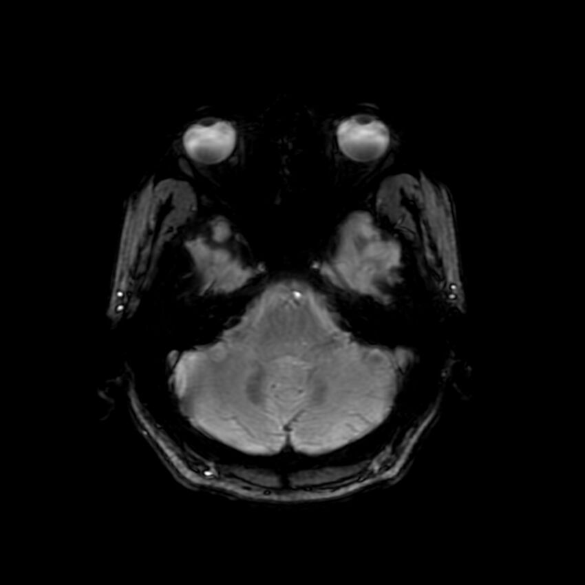Cerebral paragonimiasis (Radiopaedia 73473-84238 Axial SWI 17).jpg