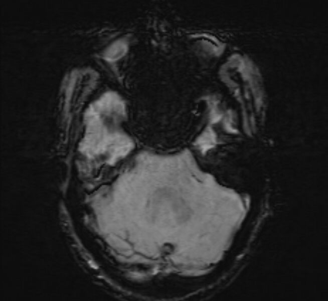 File:Cerebral venous thrombosis (Radiopaedia 71207-81504 Axial SWI 12).jpg